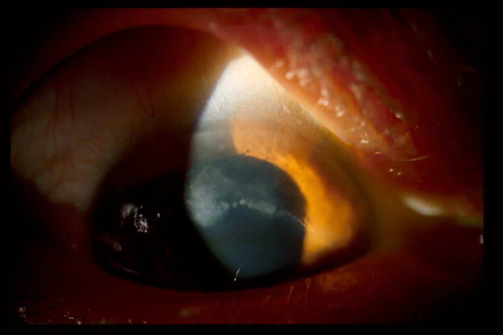 Öga med ärrbildning i cornea.